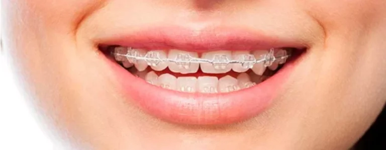 Cat costa un implant dentar si ce avantaje iti asigura? Cat costa un implant dentar si ce avantaje iti asigura?